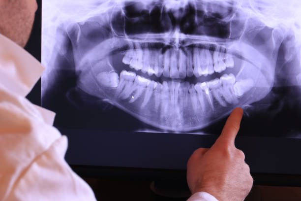 Best Emergency Dental Extractions in Lakehurst, NJ